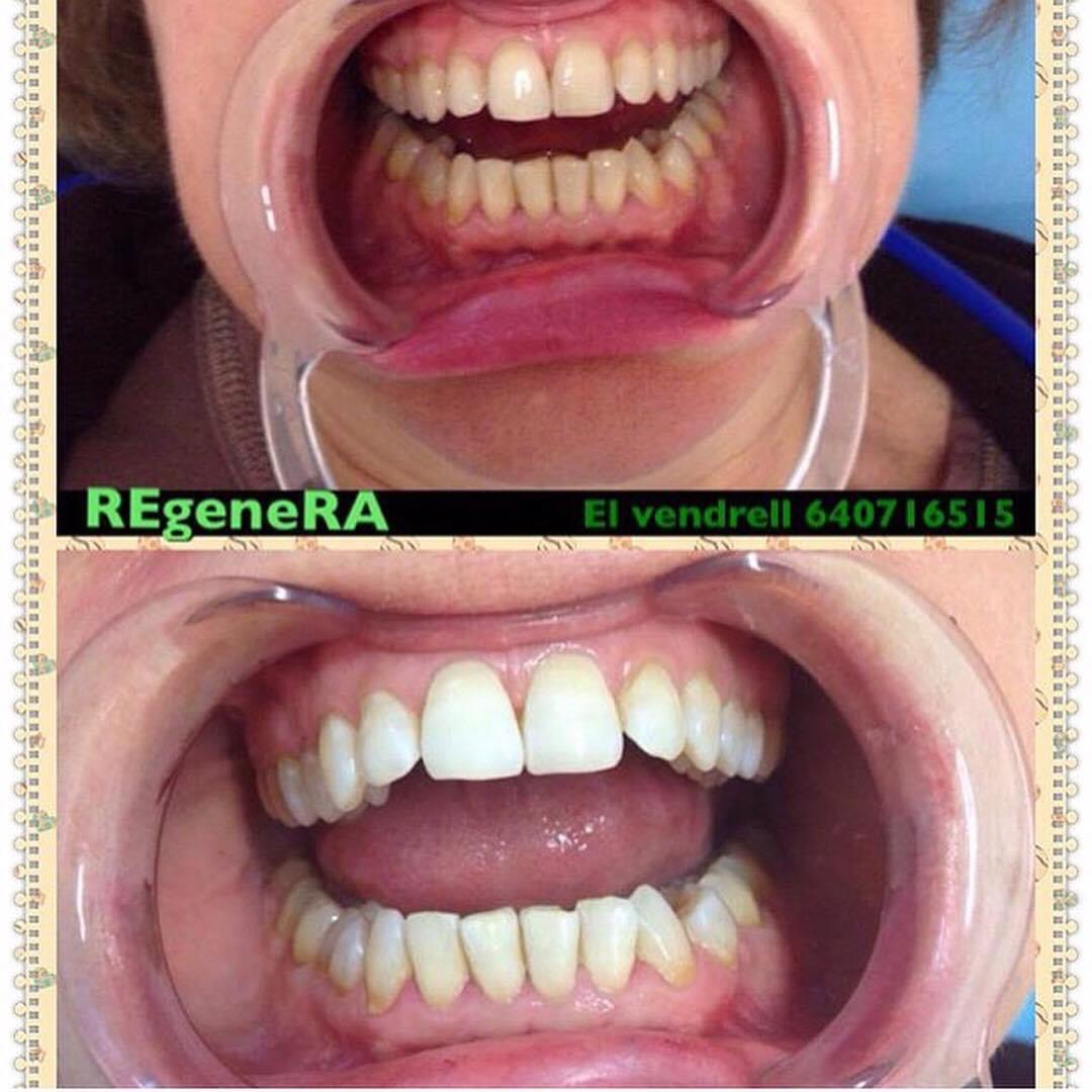 blanqueamiento-dental-estetica-regenera-1
